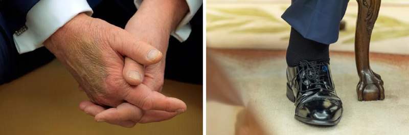 特朗普被诊断患有慢性静脉功能不全